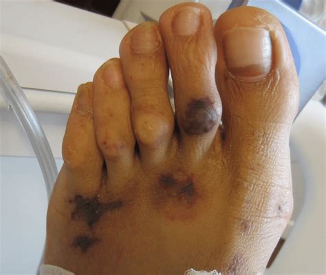 Is A Photograph Of The Macular Purpuric Rash On The Left Foot
