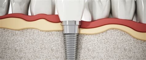 Can Dental Implants Cause Cancer