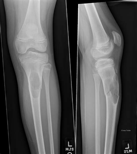 Aneurysmal Bone Cyst Radiology Case Radshare Net