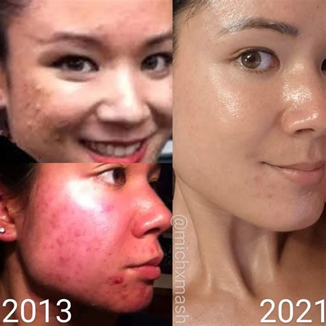 Co2 Fraxel Laser Review Did My Old Atrophic Acne Scars Improve