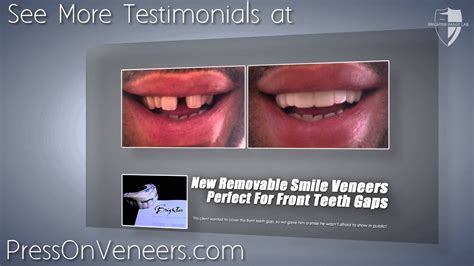 Here are some techniques that you can use to fix such gaps: Cover Front Teeth Gaps with Press On Veneers - YouTube