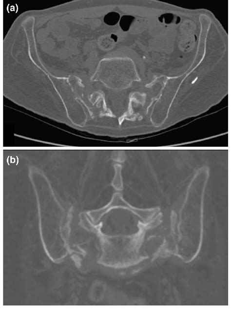 Axial A And Coronal B Ct Images Demonstrating A Nondisplaced