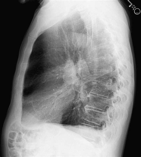 Normal Lateral Chest Radiograph