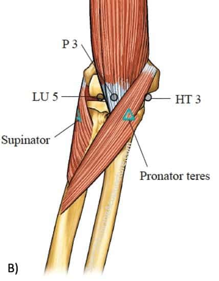 Supinator Syndrome The Great Imitator For Lateral Epicondylitis