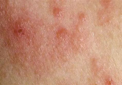 Armpit Rash Pictures Causes Fungi Heat And Treatment Curehows