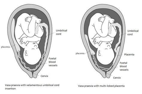 Placenta praevia is when the placenta attaches inside the uterus but in an abnormal position near or over the cervical opening. Vasa praevia - Wikipedia