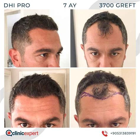 Clinicexpert Hair Transplant Review And Cost Hairanalyse