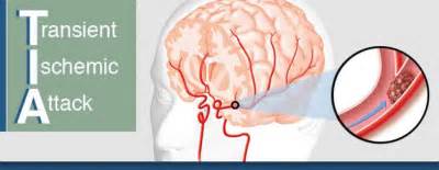 The images are similar to slices of a loaf of bread. TIA - Milka Clarke Stroke Brain Trauma Foundation