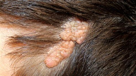 Nevus Sebaceous Causes Treatment And More