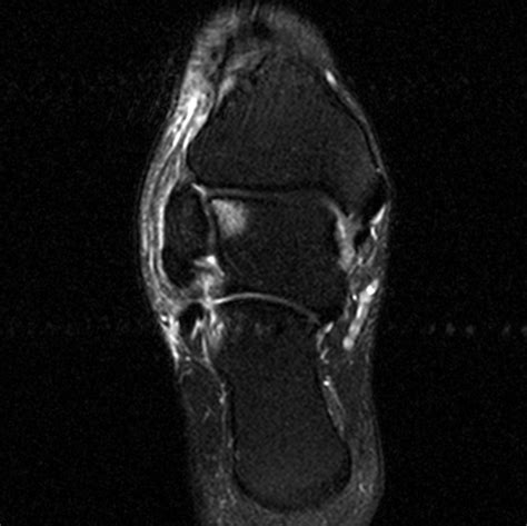 Radiologia Do Esporte Ruptura Completa Do Ligamento Calcaneofibular