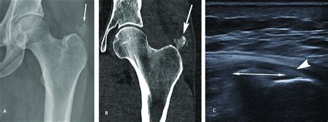 Gluteus Medius Calcific Tendinitis