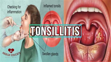 All You Need To Know About Tonsillitis Youtube