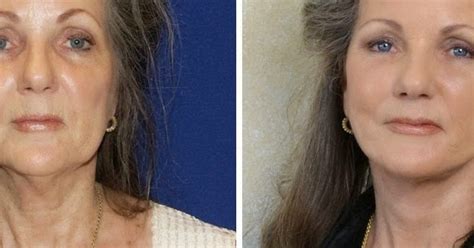 Lara devgan is a top plastic surgeon in new york city. Facial Exercises For Firming Jowls And Face Skin And ...
