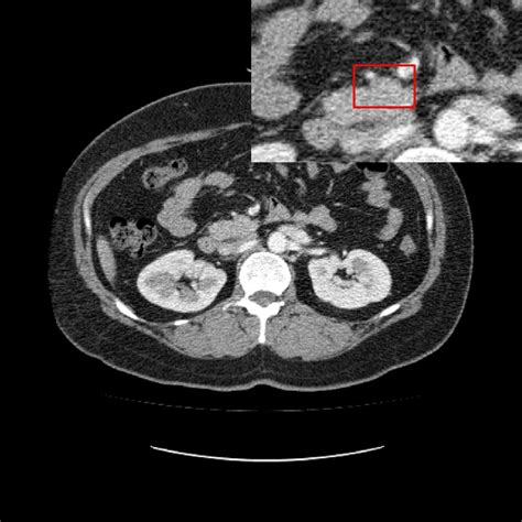 Taste Of Home Abnormal Abdominal Ct Scan With Preview Total 21 Images