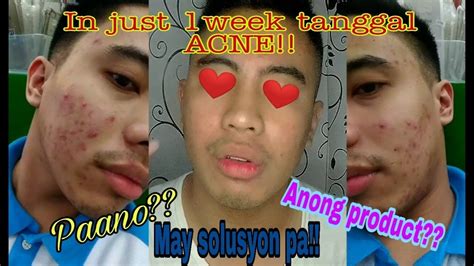 How To Get Rid Of Acne Breakout In Just 1week May Solusyon Pa
