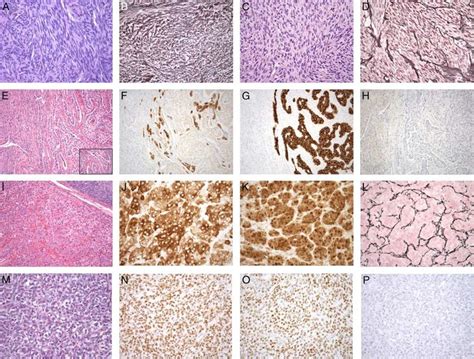Sex Cord Stromal Tumors Of The Ovary A And B Cellular Fibroma And C Download Scientific