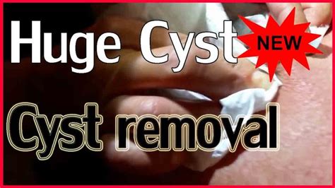Cyst Removal At Home Huge Cyst Do Not Repeat It Health And Medicine