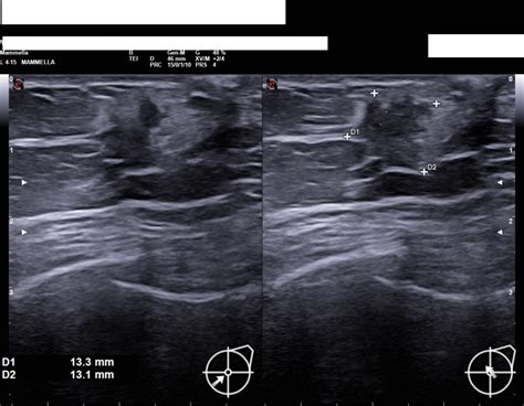 Ultrasound Of Pediatric Breast Masses What To Do With