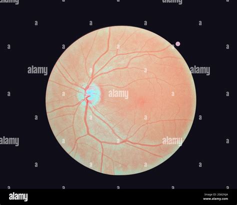 Right Eyes Retinal Image Isolated On A Black Background A Normal