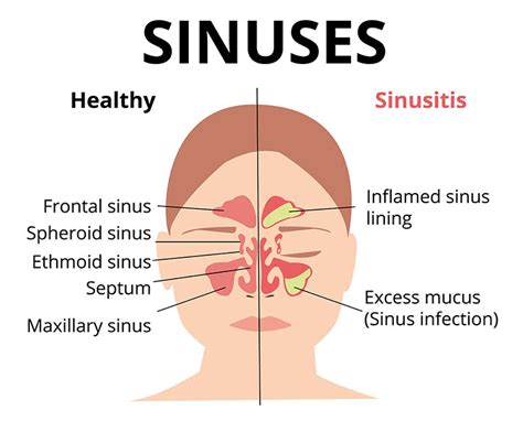 Chronic Sinusitis Sinus Infection Symptoms Sinus Treatment