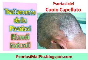 Psoriasi Mai Più | Cura la psoriasi in modo naturale ...