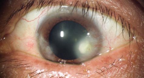 Crstoday Ocular Rosacea