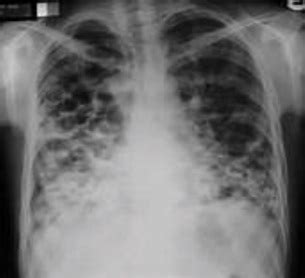 This manual would not have been possible without the comments and suggestions of colleagues with considerable. Tuberculosis radiology - Wikipedia