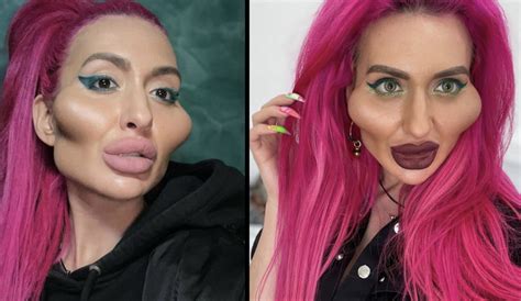 Woman With Worlds Biggest Cheeks Reveals More Surgery Plans