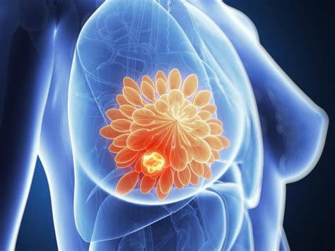 5 Services Provided By The Best Breast Cancer Surgeons In Los Angeles