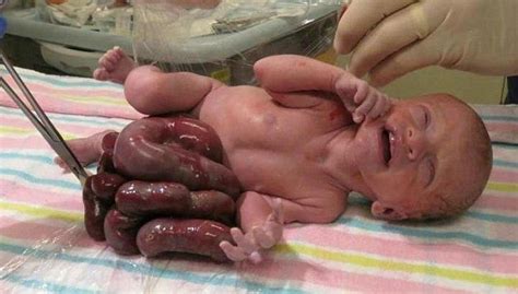 【閲覧注意】医者から「中絶した方がいい」と言われた赤ちゃんを産んだ結果・・・（画像） ポッカキット