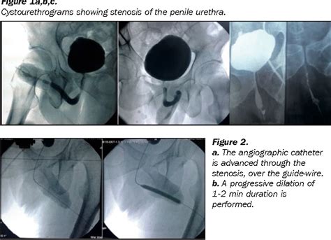 Figure 2 From Treatment Of Urethral Strictures With Balloon Dilation A
