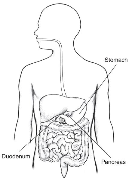 Digestive Tract With Labels For The Stomach Pancreas And Duodenum