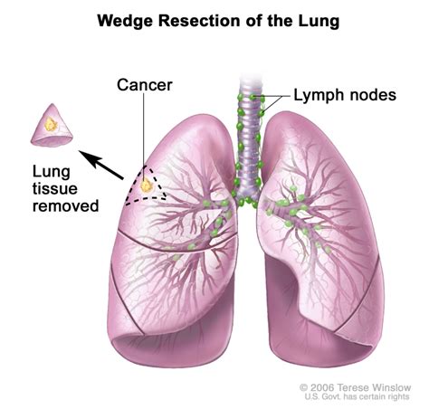 Non Small Cell Lung Cancer Treatment Pdq® Pdq Cancer Information