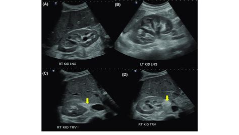 A And B Renal Ultrasound Demonstrating Bilateral Moderate