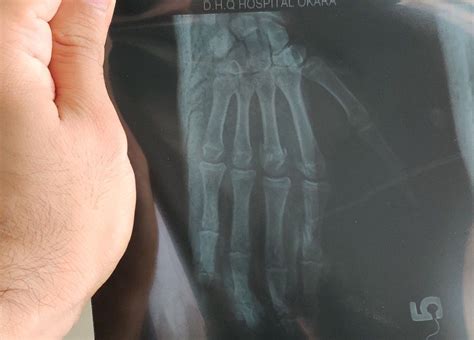 Rd Metacarpal Fracture Medizzy