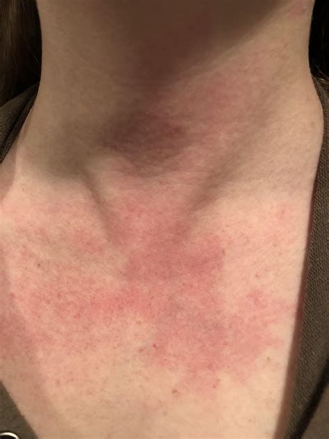Randomly Occurring Rashy Looking Discoloration On Neck And Chestanybody Else Get This Rlupus