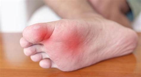 Dealing With A Sprained Toe What You Need To Know Thewellthieone