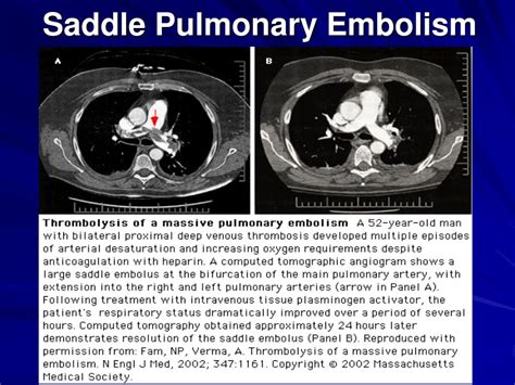 Ppt Hemodynamic Monitoring For The Respiratory Therapist Powerpoint