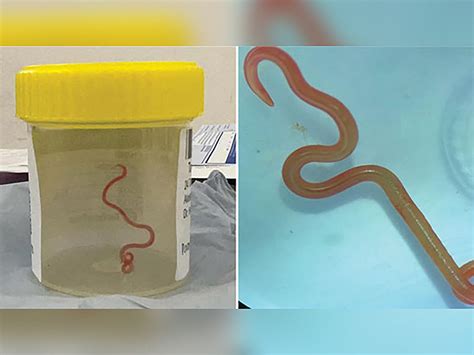 Australian Scientists Make World First Discovery Of Parasitic Worm In