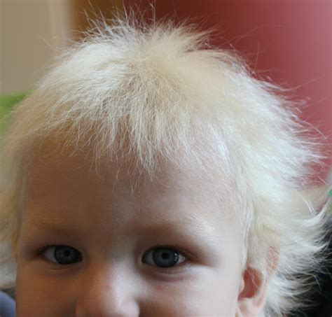 Strange But True Uncombable Hair Syndrome Stuff Mom Never Told You