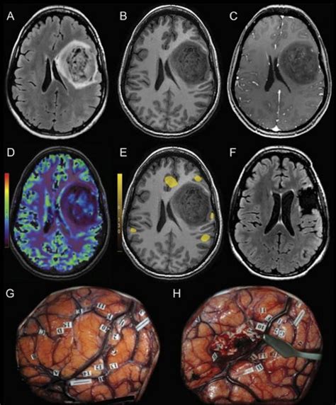 Using Fmri To Plan Brain Tumor Resection Boosts Patient Outcomes