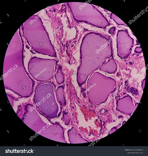 Multinodular Goitre Show Thyroid Tissue Follicles Stock Photo