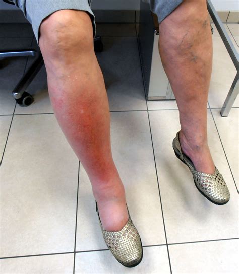 Wie Erkennt Man Eine Thrombose Im Bein Symptome Anzeichen Erkennen My
