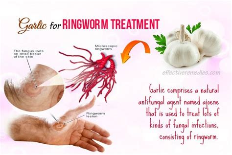 Treat Ringworm Treat Info