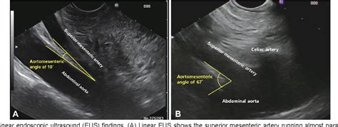 Pdf Superior Mesenteric Artery Syndrome Diagnosed With Linear