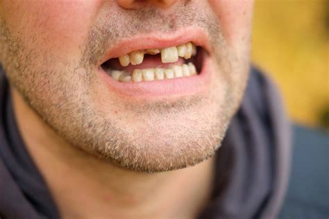 Tooth Abscess Symptoms Causes And Signs