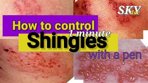 How To Treat The Shingles With A Ballpen In The Very Simple Way No