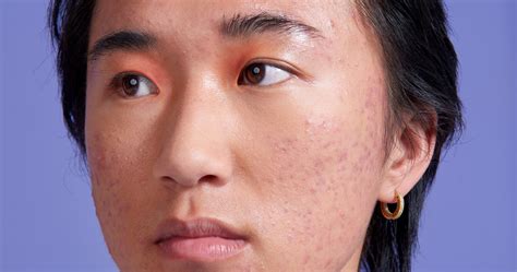 How Abandoning Skin Positivity Affects People With Acne