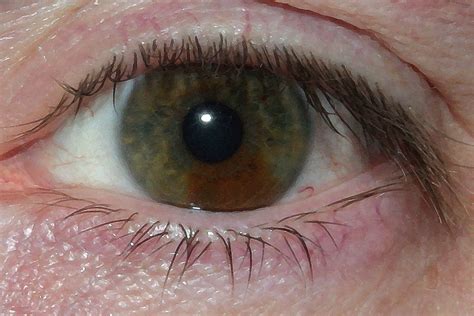 Sectoral Heterochromia Sectoral Heterochromia One Eye 2 Co Flickr