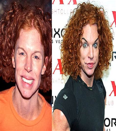 Celebrities Plastic Surgery Gone Wrong Axl Included In List Page My